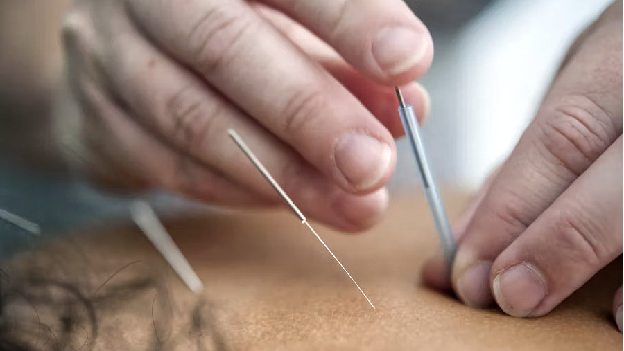 5 Ways Acupuncture Can Support Your Fertility Naturally